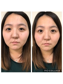 ジェミー(Gemmy)/BBL★ビフォーアフター