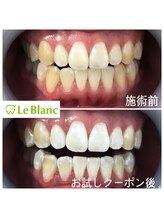 ルブラン 奈良店(Le Blanc)/犬歯の黄ばみ強い方！