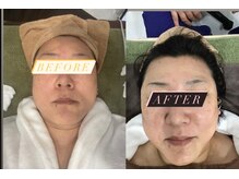 徳島美容サロン/クリスタルショットコース