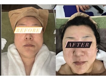 徳島美容サロン/クリスタルショットコース