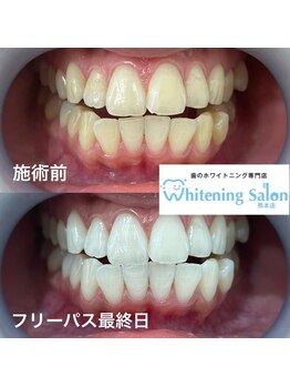 ホワイトニングサロン 熊本店/人気のセルフホワイトニンング