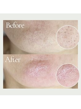 プアラ(puala)/BeforeAfter