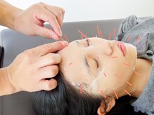 Drハリー 新宿/幹細胞パック美容鍼