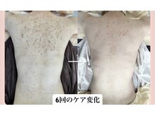 スキンハピネス(skinhappiness)/背中ハーブピーリング