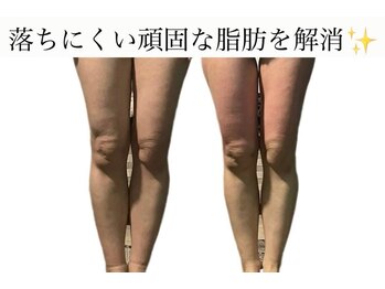 痩身革命 大宮店/膝の黒ずみ対策★