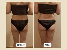 ミリュー(mylieu)/脱・リバウンドならルルオン一択