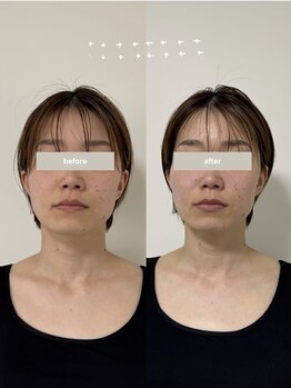 こつこつラボ サンイチマル オオル(310/OOL')/［30代/むくみ/左右差/歪み］