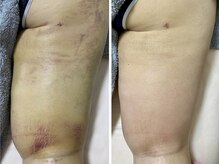 インディバ ミマリ(INDIBA ミマリ)の雰囲気（お尻下部分と太ももの吸引後ケア左：8日目ケア前　右：ケア2回目）