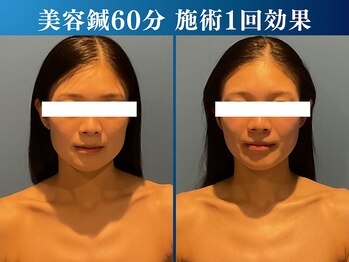 シンク 表参道(CINQ)/食いしばり・噛み締め