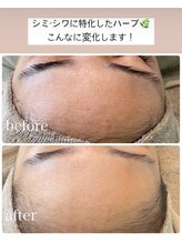 エスポワール/シミ特化型国産ハーブピーリング