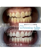 ホワイトニングサロン 福岡天神店/ホワイトニング