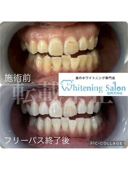 ホワイトニングサロン 福岡天神店/ホワイトニング