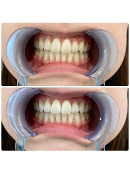 コナホワイトニング 神保町/セルフホワイトニング神保町