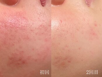 ウォーム(warm)/乾燥/敏感肌/赤み/フェイシャル