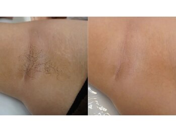 リムーブ(Re:move)/【上半身脱毛Before→After】