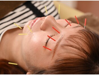 ホープ鍼灸整骨院/美容鍼の施術風景