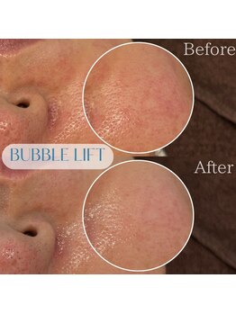 バブルビューティー(Bubble beauty)/LDM水玉リフティング