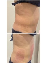 ルキア(LUKIA)/痩身【脂肪冷却】症例４　おなか