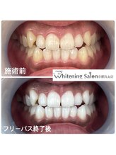 ホワイトニングサロン 京都烏丸店/ホワイトニング施術例