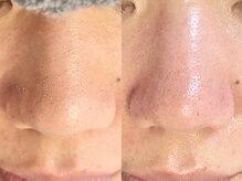 アイラッシュサロン ココ(CoCo)/毛穴エクストラクションプロ