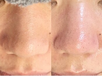 アイラッシュサロン ココ(CoCo)/毛穴エクストラクションプロ