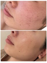 ニコリ(Nicori)/毛穴や乾燥お悩みに！