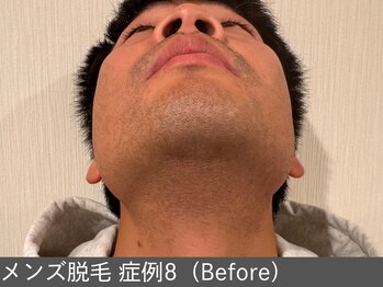 オアシスラグーン(OASIS LAGOON)/メンズ脱毛(症例8 before)