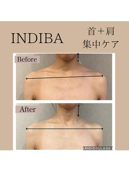 リーチェ ビューティー(Riche Beauty)/巻き肩・首こり・歪み改善