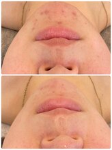 トゥモロー(TOMORROW)/ハーブピーリング/肌質改善