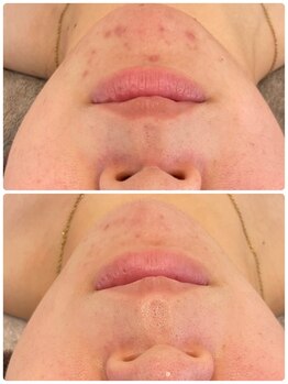 トゥモロー(TOMORROW)/ハーブピーリング/肌質改善