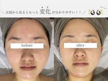 ベベ 表参道(bebe)/水光トゥインクルトリートメント