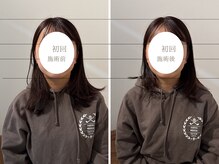 トイ鍼灸接骨院(TOY鍼灸接骨院)/●美容鍼灸