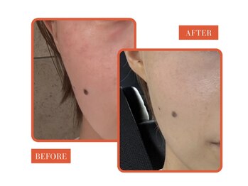 エナ(ENAK)/ララホワイトで日焼けしない肌に