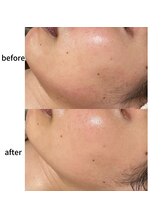 ルアラナ(Lualana)/アンストレストリートメント