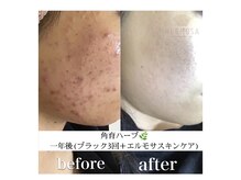 エルモサハーブニキビ・肌荒れ・シミ・シワ