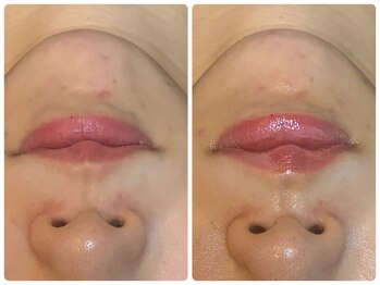 フォルスボーテ(Force Beaute)/ヒアルロン酸いらず♪唇ぷっくり