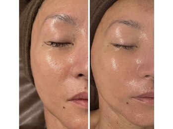 銀座エイジングケアサロン/ビフォーアフター♪