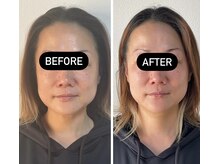 【速攻小顔・リフトUPテラボーラ】 ビフォー・アフター