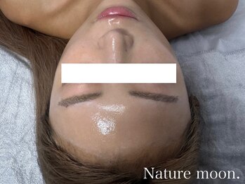 ナチュールムーン(Nature moon.)/ハーブピーリング　after