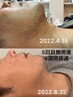 【メンズ毛穴洗浄吸引＋ヒゲ/顔脱毛(全顔）】繰り返す肌荒れ、ニキビケアに