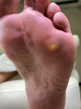 フットメンテ 巻き爪矯正センター 南浦和/痛～い魚の目