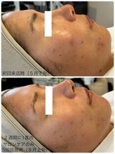 ミニマル(minimal)/5回施術目