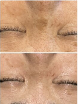 ベリール バイ ラスティ(Belile by LUSTY)/シミケア