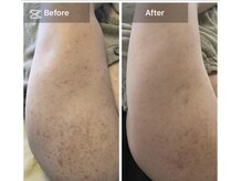 モカ 天王寺店(MOKA)/剥離◯3回目　二の腕ケア