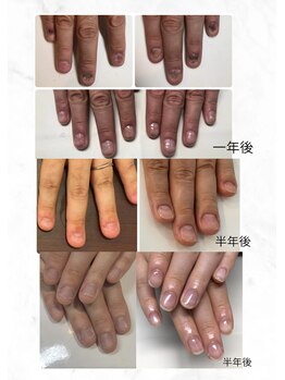 ティアラネイル 宇都宮/深爪矯正