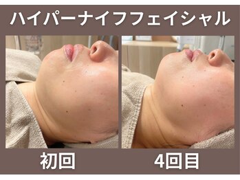 グローアップ(Glow up)/HKフェイシャルビフォーアフター
