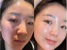 マリヴェリーテ(Mari verite)/ニキビ×毛穴詰まり改善【15回】