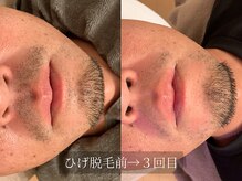 アルム(Arum)/デザインひげ脱毛