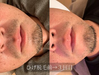 アルム(Arum)/デザインひげ脱毛