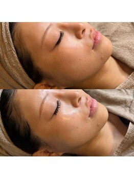 ココミーサロン(CoCo me salon)の写真/【韓国肌管理】GPEEL★ラミネーションピール★毛穴・くすみ・ツヤ肌◎艶肌へ